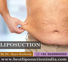 liposuction