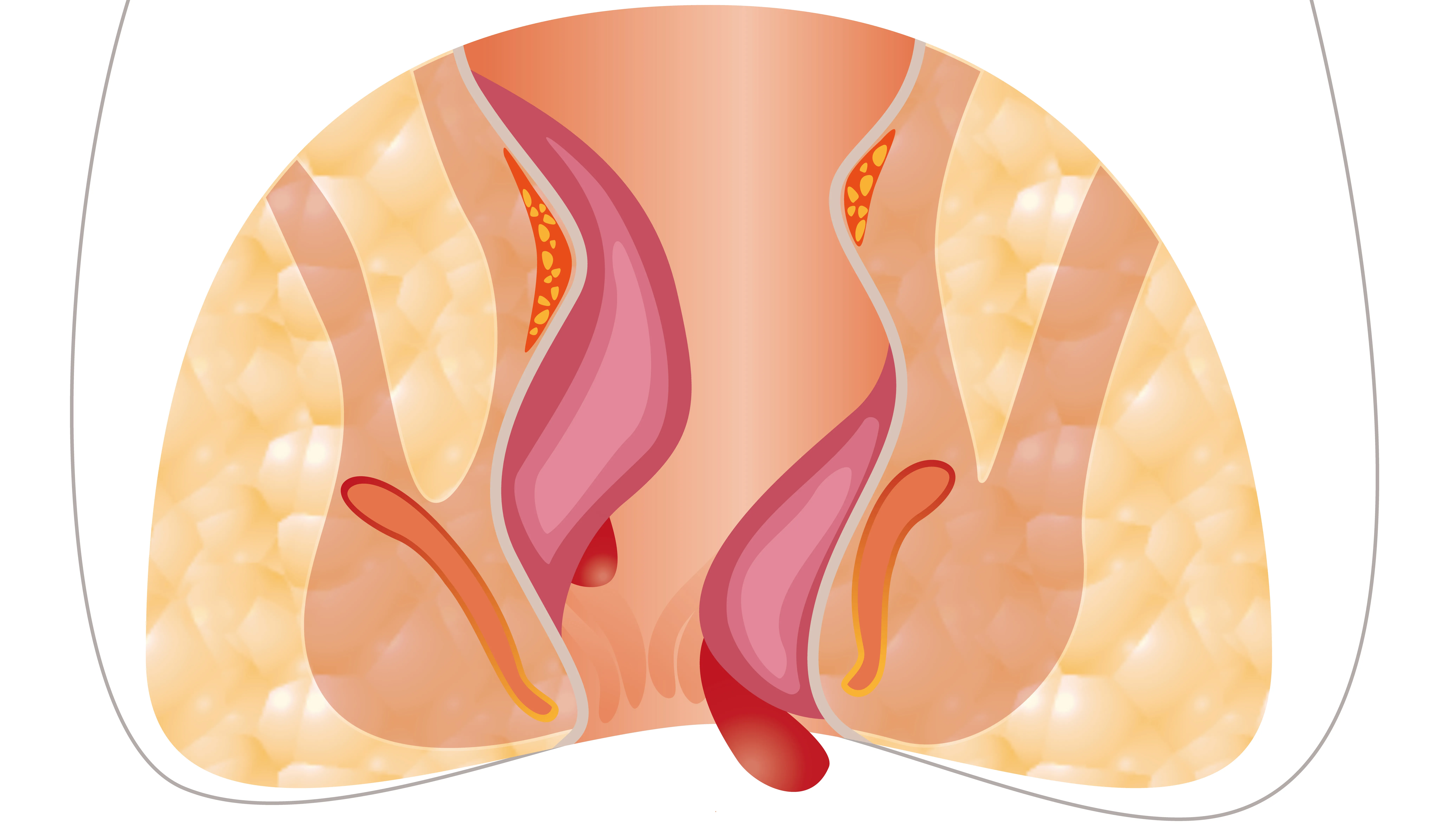 Best Piles Treatment